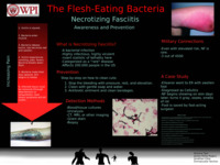 The Flesh-Eating Bacteria: Necrotizing Fasciitis thumbnail